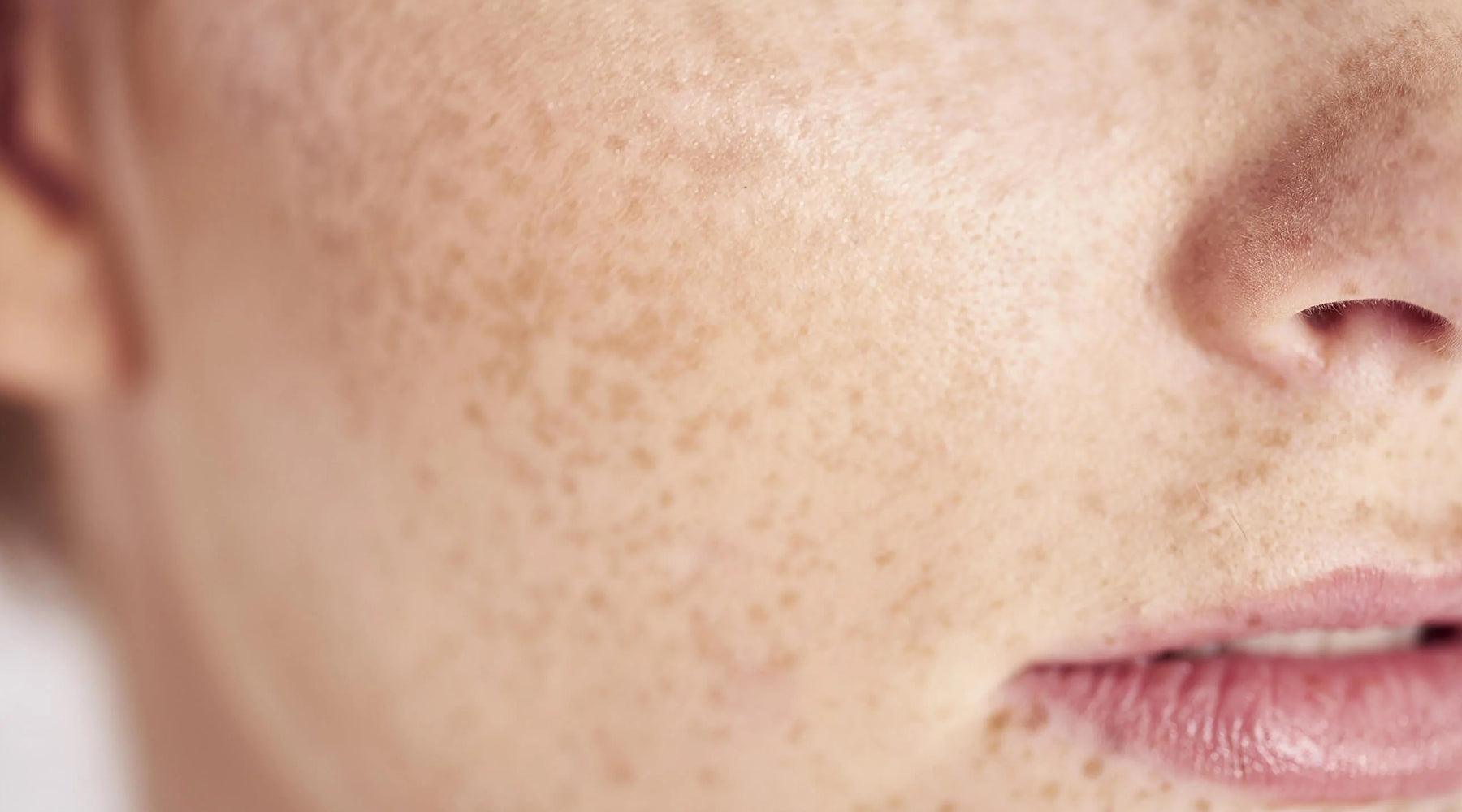 Seeing Spots? The Realities of Hyperpigmentation - K-Beauty Arabia